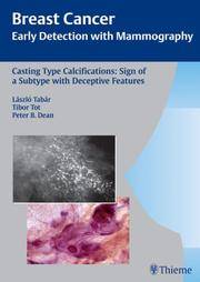 Casting Type Calcifications: Sign of a Subtype With Deceptive Features