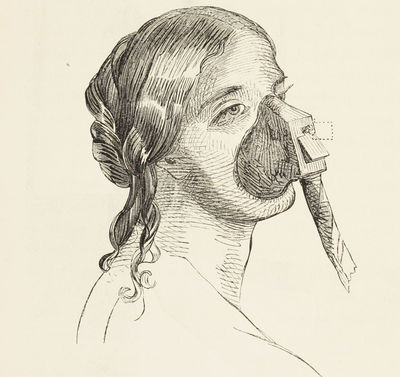 On the Inhalation of the Vapour of Ether in Surgical Operations: containing a Description of the Various Stages of Etherization and a Statement of the Result of nearly Eighty Operations in which Ether has been employed in St. George's and University College Hospitals