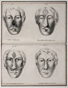 Restauration complete du nez, d'apr�s la m�thode de M. Dieffenbach