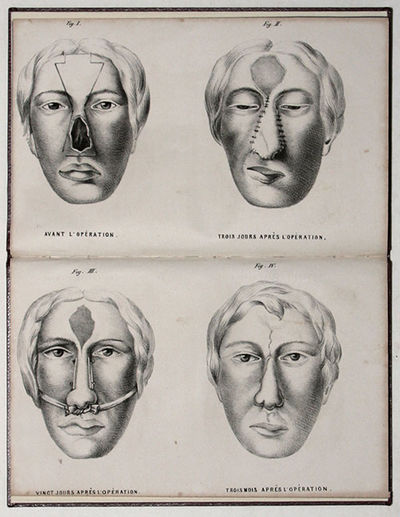 Restauration complete du nez, d'apr?s la m?thode de M. Dieffenbach