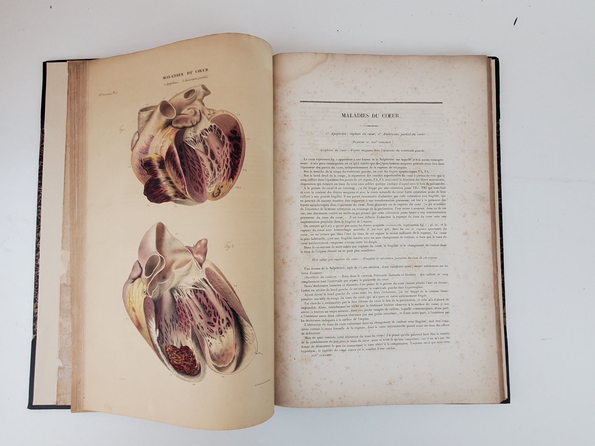 ANATOMIE PATHOLOGIQUE DU CORPS HUMAIN, OU DESCRIPTIONS, AVEC FIGURES
