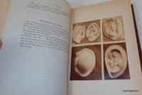 [Photographically Illustrated Books] Haematoma Auris IN The American Journal of Insanity Vol XXVII