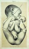 A Practical Treatise on the Aetiology, Pathology, and Treatment of the Congenital Malformations of the Rectum and Anus