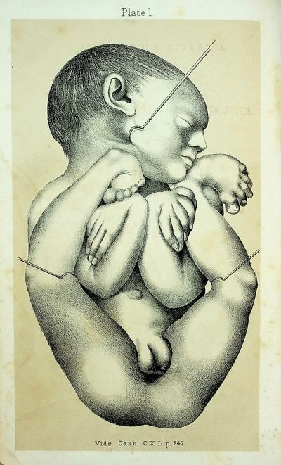 A Practical Treatise on the Aetiology, Pathology, and Treatment of the Congenital Malformations of the Rectum and Anus