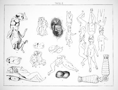 1882 Die Missbildungen des Menschen [Human Malformations]