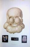 Traite d'Anatomie Pathologique Generale et Speciale [Treatise on Pathologic Anatomy, General and Special]