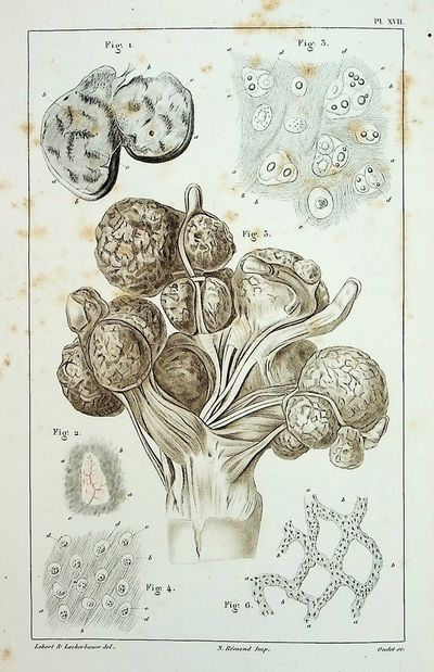 Physiologie Pathologique ou Recherces Cliniques, Experimentales et Microscopiques, sur l'Inflammation, la Tuberculasation, les Tumerus, la Formation du Cal, Etc. [Pathologic Physiology or Clinical Research, Experimental and Microscopic, on Inflammation, Tuberculosis, Tumors, Formation of Calcification, Etc.]