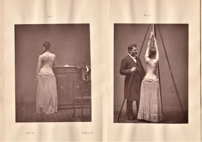 Spinal Disease and Spinal Curvature. Their Treatment by Suspension and the Use of the Plaster of Paris Bandage