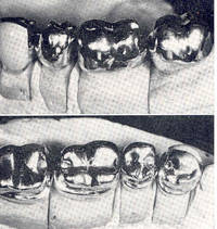 Partial denture construction, principles and techniques. [The clasp partial denture; Occlusal rests; Direct retainers; Preparation of abutment teeth; Miscellaneous partial prosthodontics; Relining and rebasing the partial denture; etc]