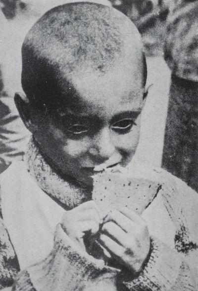Maladie de Famine: Recherches Cliniques sur la Famine Exécutée dans le Ghetto de Varsovie en 1942