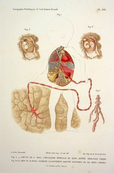 Iconographie Pathologique de l'Oeuf Humain Feconde en rapport  avec l'Etiologie de l'Avortement [Pathological Iconography of the Fertilized Human Egg in Relation to the Etiology of Abortion]