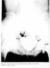 The Ureterovesical Junction. The Theory of Extravesicalization of the Intaravesical Ureter