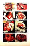 Neurosurgery of Infancy and Childhood