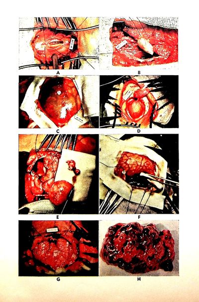 Neurosurgery of Infancy and Childhood