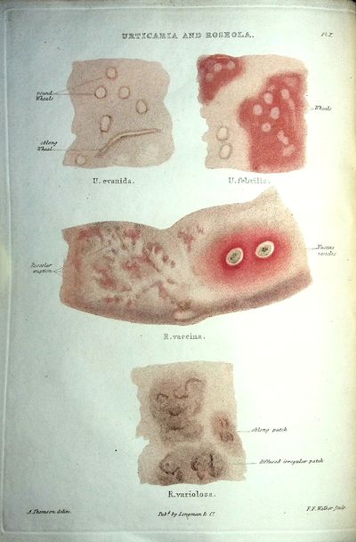 Atlas of Delineations of Cutaneous Eruptions Illustrative of the Descriptions in the Practical Synopsis of Cutaneous Diseases of Thomas Bateman