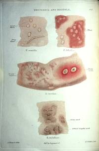 Atlas of Delineations of Cutaneous Eruptions Illustrative of the Descriptions in the Practical Synopsis of Cutaneous Diseases of Thomas Bateman