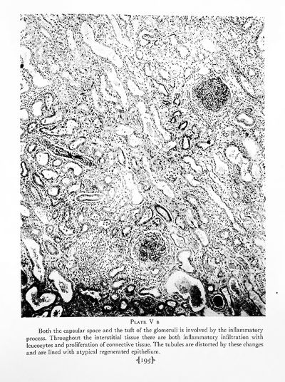 The Renal Lesion in Bright's Disease