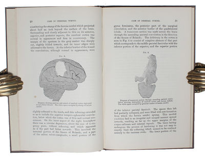 Case of Cerebral Tumor. Read May 12th, 1885. [Offprint from "Medico-Chirurgical Transactions", Vol. 68]. - [FIRST REMOVAL OF A BRAIN TUMOR] (photo 4)