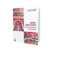 Mini-implants: The Orthodontics of the Future
