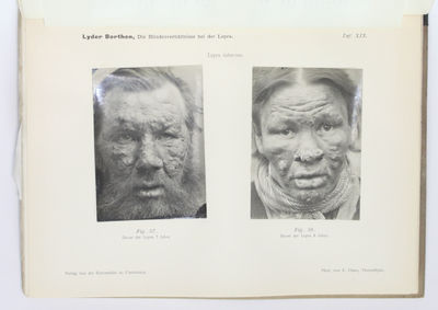 Die Lepra des Auges. Klinische Studien. Mit pathologisch-anatomischen Untersuchungen von H. P. Lie. Mit 17 Textfiguren, 15 Lichtdruck und 9 chromolithographischen Tafeln. (photo 2)