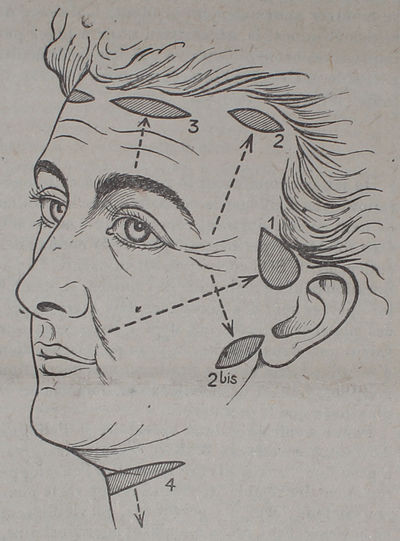 La Chirurgie Esthétique des Rides du Visage. [In:…