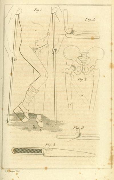 On the treatment of anchylosis, by the formation of artificial joints