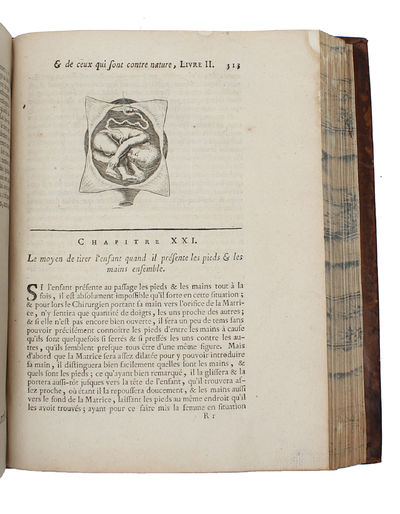 Traité des maladies des femmes grosses et de celles qui sont accouchées (...). Tome Premier (+) Observations sur la grossesse et l'accouchement des femmes et sur leurs maladies et celles des enfans nouveau-nés en chacune desquelles les causes et les ... - [“ESTABLISHED OBSTETRICS AS A SCIENCE"] (photo 6)